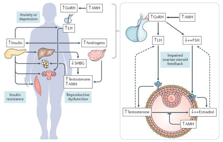 An illustration of PCOS