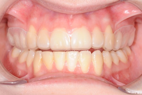 Tandraden med skena.