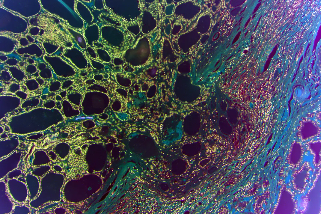 Decorative histological image of a tumor.