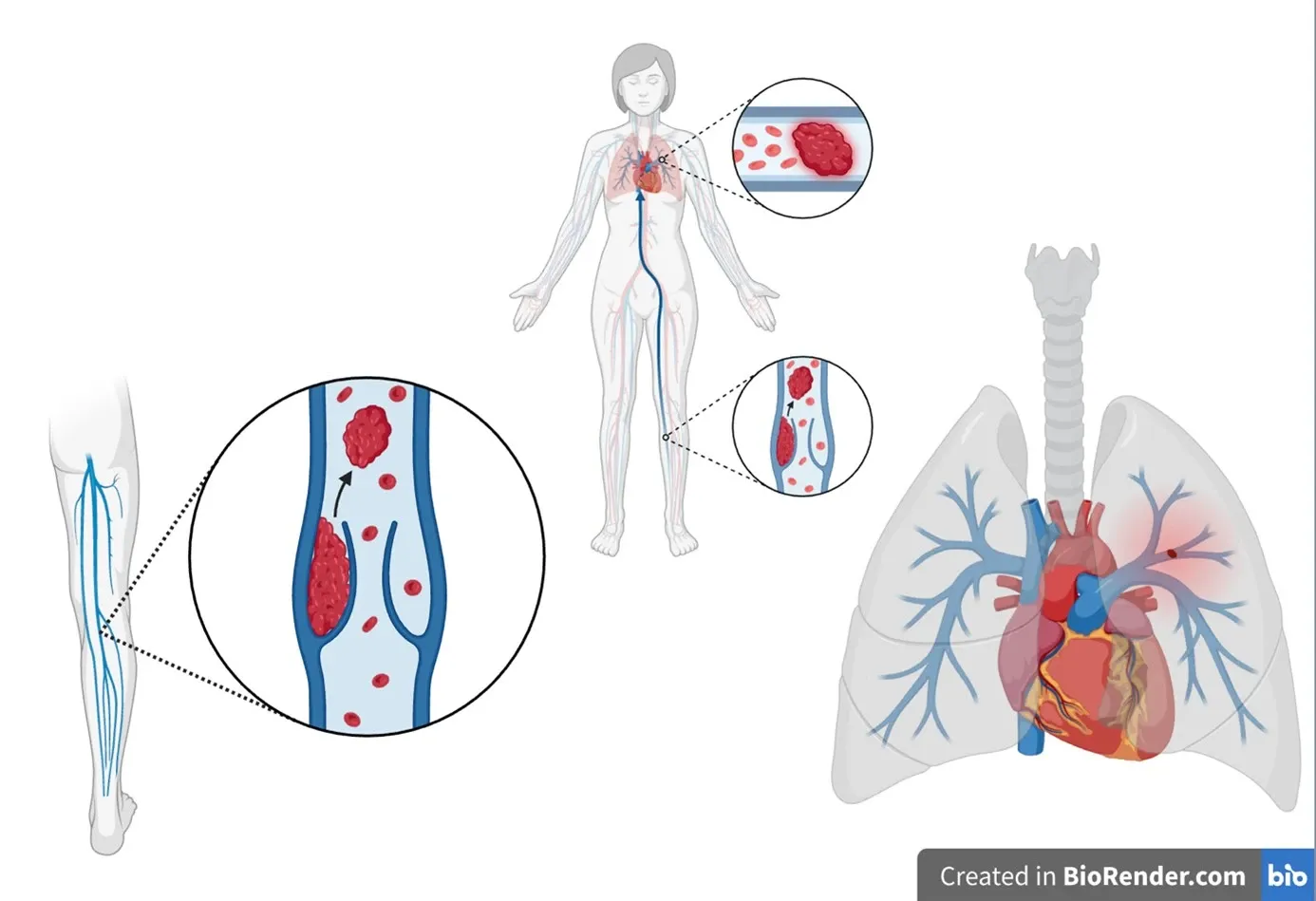 venous thromboembolism