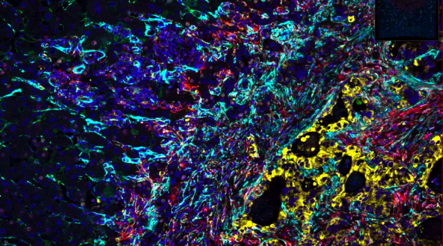 Fluorescent protein stains of tumor growing in the liver.