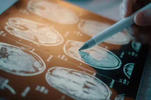 Doctor pointing a pen at a MRI scan of the brain.