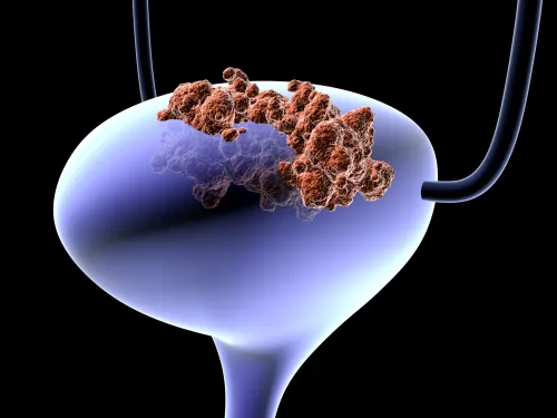 Illustration of urine bladder with tumour.
